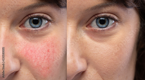 Collage comparing healthy skin and face suffering rosacea, visible blood vessels and capillaries. Caucasian woman face closeup. Medicine and healthcare concept...