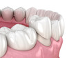 © Alex Mit - Preparated premolar tooth and dental crown placement. Medically accurate 3D illustration