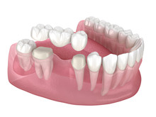 Dental Bridge Of 3 Teeth Over Molar And Premolar. Medically Accurate 3D Illustration Of Human Teeth Treatment