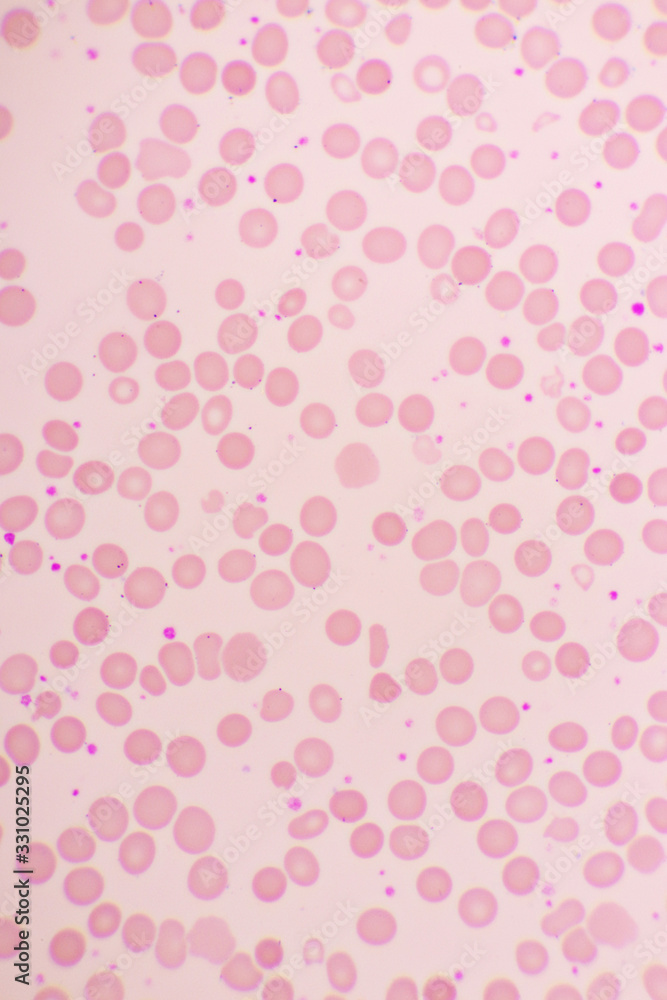 Essential thrombocytosis blood smear, present abnormal high platelet ...