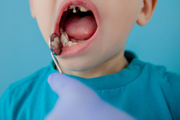 Close up of dentist's hands with assistant in blue gloves are treating teeth to a child, patient's face is closed