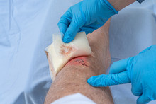 Nurse Caring Fresh Blooded Injury Wound On The Tibial Bone Of The Leg. Sticking Stitches To Hold The Cut.
