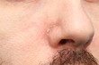 © Stanislav - Part of the face with the nose of an adult white man with dry, flaky skin. Skin problems and diseases