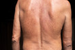 © yongyut - Problem skin rash from allergy symptoms.