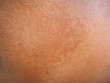 Blemish and freckles on face in asian woman more than thirty year old cause of ultraviolet (UV) or blue light using for sunscreen cream,gel and skincare or beauty product concept.