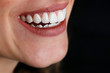 smile design, laminate veneers, dentistry.