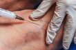 © Yashkin Ilya - Injections into the veins of an elderly woman's leg close-up. Doctor's injections in the veins of an old woman's legs. Treatment of varicose veins. Varicose veins injections