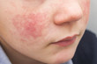 Boy with red cheeks- diathesis or allergy symptoms. Redness and peeling of the skin on the face. 