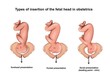Illustration of the types of insertion of the fetal head in obstetrics
