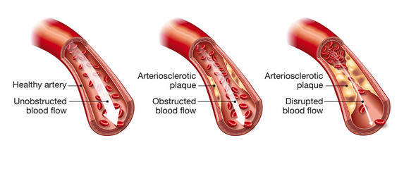 Arteriosclerosis, illustration showing healthy blood vessel and beginning of arteriosclerosis