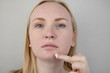 A woman examines dry skin on her face. Peeling, coarsening, discomfort, skin sensitivity. Patient at the appointment of a dermatologist or cosmetologist, selection of cream for dryness