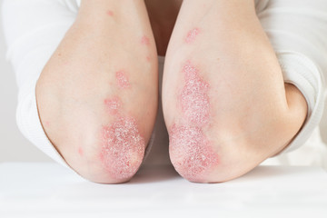 acute psoriasis on the elbows is an autoimmune incurable dermatological skin disease. large red, inf