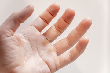 Hand with blister and callus on white background