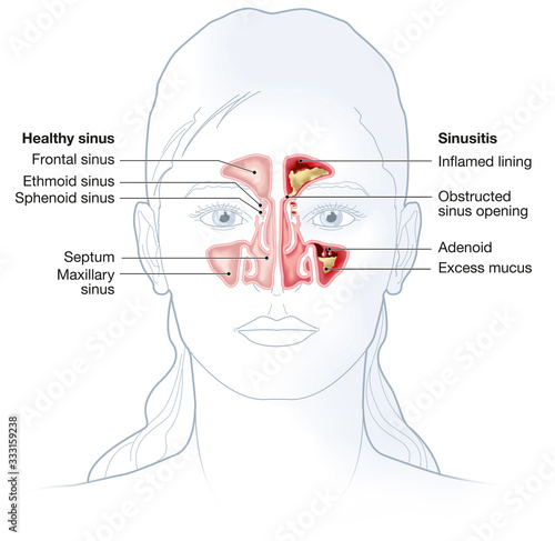 Healthy Sinus And Sinusitis Medical Illustration Labeled Stock Illustration Adobe Stock
