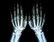 Film X-ray of Rheumatoid arthritis hand shows joint space narrowing of hand . Rheumatoid arthritis patient 's hand in x-ray. Medical and healthcare shot . Radiology concept.