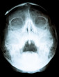 x ray of skull with open mouth.
