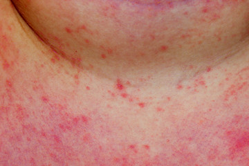 A child with severe heat rash on his neck and chest coused by warm and humid summer.