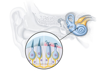 Wall Mural - Tinnitus, healthy and damaged hair cells inside cochlea, medical illustration