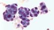 Malignant fluid cytology;   Malignant cells of adenocarcinoma may spread to fluid of  pleural or peritoneal cavity in cancer from the breast,  lung, colon, pancreas, ovary, endometrium or other sites.