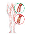 Peripheral artery occlusive disease, intermittent claudication, medical illustration