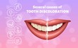 Medical poster showing causes of tooth discoloration. Educational infographic concept. Realistic vector illustration.