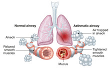 Asthma, Normal And Asthmatic Airways, Medically Illustration
