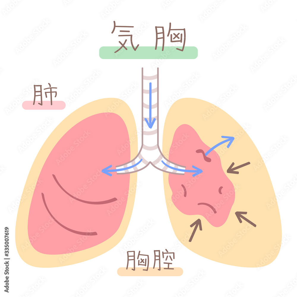 Vector de Stock 肺の図表(気胸) | Adobe Stock