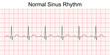 © JYFotoStock - Electrocardiogram show normal heart beat line (Sinus rhythm). ECG. EKG. Vital sign. Medical healthcare symbol.