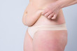 © staras - Tummy tuck, flabby skin on a fat belly, plastic surgery concept