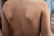 © Mladen - Skin disease.