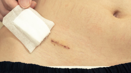 male teen hand removing patch showing fresh appendix surgical wound after suture removal in appendec