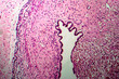 Ovarian cyst, light micrograph, photo under microscope