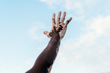 Man's Hand With Vitiligo Against Cloudy Sky