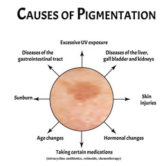 Pigmentation on the skin causes. Brown spots on the skin. Pigmentation treatment. Infographics. Vector illustration on isolated background.