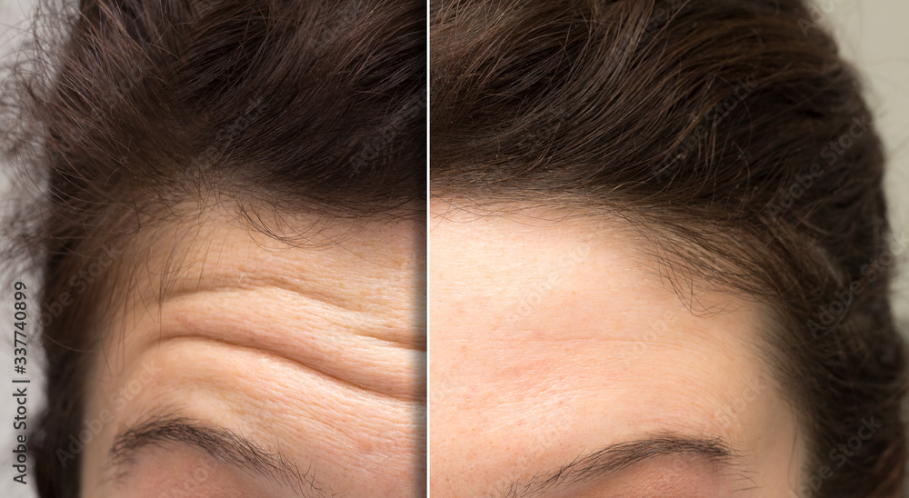 face of a woman before and after a botox treatment to smooth expression lines. Concept of anti-aging and rejuvenation cosmetics on forehead wrinkles - obrazy, fototapety, plakaty 