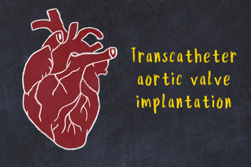 Wall Mural - Concept of learning cardiovascular system. Chalk drawing of human heart and inscription Transcatheter aortic valve implantation