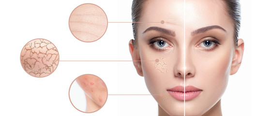 female face close-up, showing skin problems. dry skin, acne, wrinkles and other imperfections. rejuv
