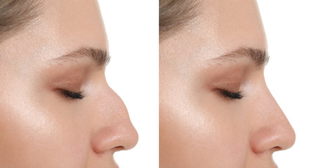 Wall Mural - Woman before and after rhinoplasty on white background