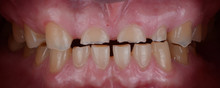 The Chipped And Worn Teeth