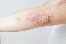 Acute Psoriasis On Elbows Is An Autoimmune Incurable Dermatological Skin Disease. Large Red, Inflamed, Flaky Rash On The Knees. Joints Affected By Psoriatic Arthritis.