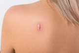 Fototapeta  - keloid scar on the back of a woman