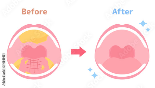 口腔ケアのイラスト ビフォーアフター Stock Vector Adobe Stock 口腔ケアのイラスト ビフォーアフター Stock Vector Adobe Stock