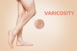 Varicosity. Smooth female legs, shown in profile, show varicose veins. Enlarged image of vessels in a circle. Beige background. The concept of varicose disease