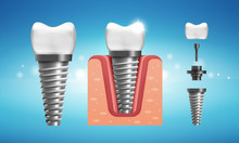 Dental Implant Structure In Realistic Style.Human Teeth With Gum.  Medically Accurate. Vector Illustration