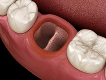 Alveolits - Opened Dry Soket After Tooth Extraction. Medically Accurate 3D Illustration