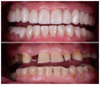 full mought recovery by press ceramic crowns and implants