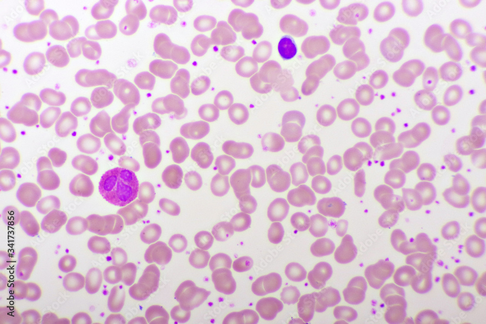 Stock-Foto „Essential thrombocytosis blood smear, present abnormal high ...