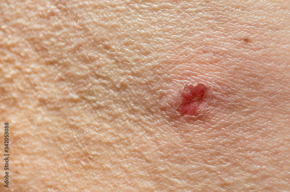 Itchy skin.Torn skin at the site of inflammation. Peeling and combing ...