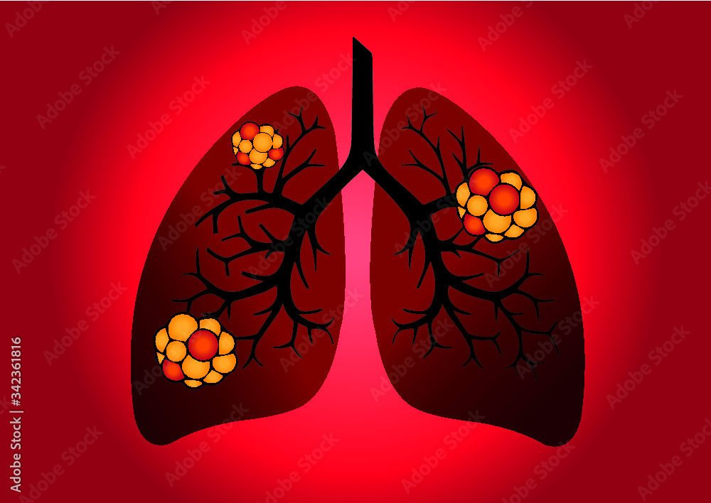 Comparison between healthy lung and cancer lung isolated on white ...