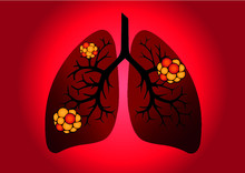Comparison Between Healthy Lung And Cancer Lung Isolated On White Background. Healthy Lung And 
Pneumonia. Lung Was Infected By Pathogen 